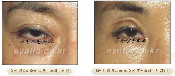 Duhan Plastic Surgery Ophthalmic Reoperation - What Is a Successful Double Eyelid Revision Surgery? image 6