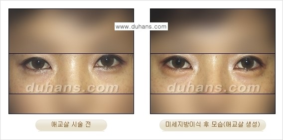 [두한성형외과 경쟁력 미세지방이식] - [눈밑 애교살을 위한 미세지방이식 1.] 관련 이미지 7
