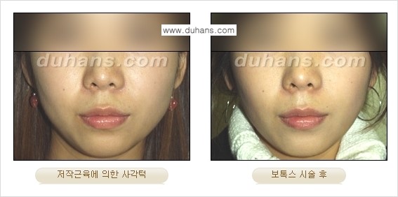 [두한성형외과 각진 얼굴을 갸름한 얼굴형으로의 변신] - [사각턱 보톡스] 관련 이미지 9