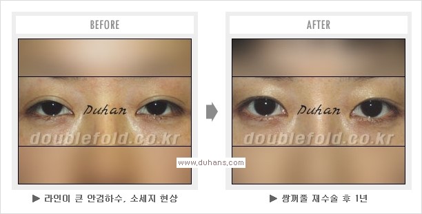 [두한성형외과 경쟁력 쌍꺼풀 재수술, 극한 눈재수술] - [망친 쌍꺼풀, 망가진 쌍꺼풀 복원수술, 재수술의 성공요건] 관련 이미지 15