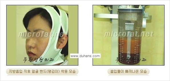​[두한성형외과 경쟁력 지방이식] - [지방이식 부작용 이후 마이크로 지방흡입, 마이크로 지방흡입 이후 부작용 없는 지방이식 방법] 관련 이미지 5