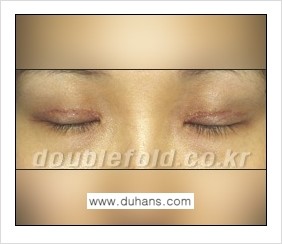 [두한성형외과 경쟁력 쌍꺼풀 재수술] - [쌍꺼풀 재수술의 대상과 해당 쌍꺼풀 재수술 방법 안내] 관련 이미지 4