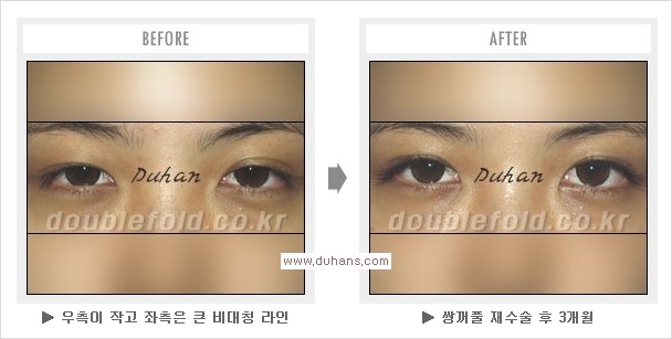 ​[두한성형외과 경쟁력 쌍꺼풀 재수술] - [아름다운 쌍꺼풀 선의 기준과 쌍꺼풀 재수술시 검사와 테스트 안내] 관련 이미지 11
