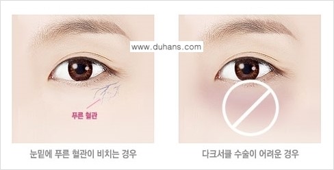 [두한성형외과 경쟁력 다크써클 치료] - [다크써클 5단계로 이뤄지는 핵심 5 STEP SOLUTION 안내 1.] 관련 이미지 8