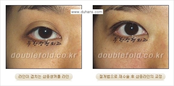 ⁠[두한성형외과 경쟁력 쌍꺼풀 재수술, 극한 눈재수술] - [삼중(세겹) 쌍꺼풀 라인의 교정] 관련 이미지 8