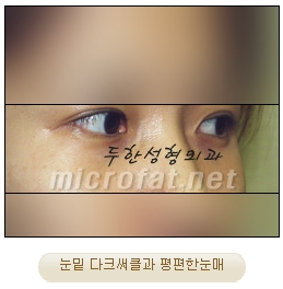 두한성형외과 눈밑성형 - 애교필러 후 눈밑재수술 관련 이미지 6