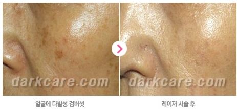[두한성형외과 콤비프로그램] - [다크서클 + 검버섯 레이저] 관련 이미지 11
