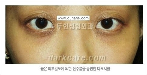 ​﻿﻿﻿﻿﻿[두한성형외과 경쟁력 눈밑성형] - [다크써클의 원인 안내] 관련 이미지 8