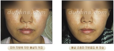 [두한성형외과 안전한 지방흡입] - [얼굴지방흡입] 관련 이미지 28
