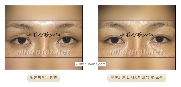 [두한성형외과 경쟁력 미세지방이식] - [꺼진(함몰된) 윗눈꺼풀 미세지방이식] 관련 이미지 8