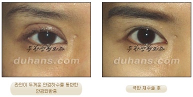 [Special Double Eyelid Revision Surgery at Duhan Plastic Surgery] - [Restorative Surgery for Damaged Double Eyelid Eye Shape] image 19