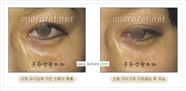 [두한성형외과 겨울엔 지방흡입을] - [볼살, 눈밑, 턱선의 초음파 미세지방흡입 2.] 관련 이미지 14