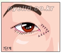 [Duhan Plastic Surgery Eyelid Surgery] - [Epicanthoplasty, Medial Canthoplasty] image 9