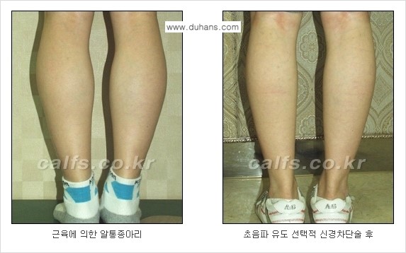 [두한성형외과 경쟁력 있는 종아리성형] - [종아리 축소 관련 흔한 질문과 답변들 1.] 관련 이미지 2