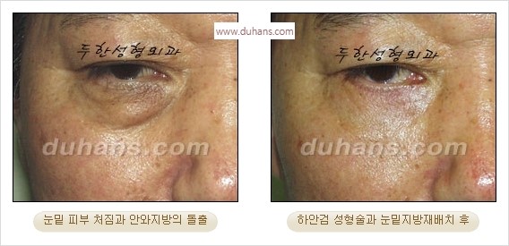 [두한성형외과 경쟁력 안검성형] - [눈밑주름 제거수술] 관련 이미지 7