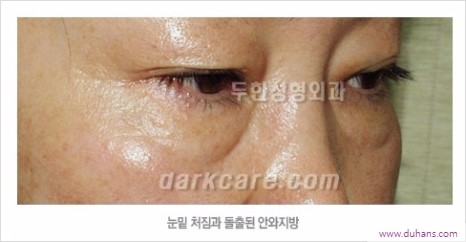 [두한성형외과 경쟁력 눈밑성형] - [하안검성형(눈밑주름제거술)과 눈밑지방재배치안내] 관련 이미지 1