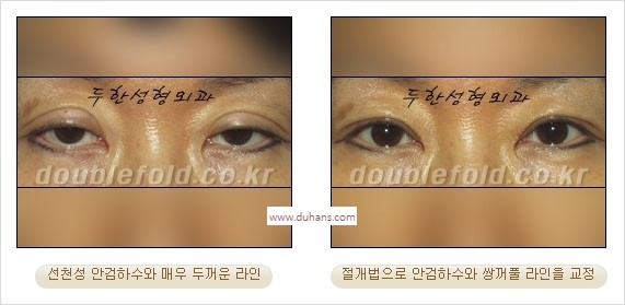 ⁠⁠[두한성형외과 경﻿쟁력 쌍꺼풀 재수술] - [안검하수(졸리운 눈매) 종류와 교정 방법 안내] 관련 이미지 24