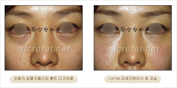 [두한성형외과 경쟁력 눈밑성형] - [Dr. 컬럼 - 눈밑 다크써클의 치료 방법과 치료 효과] 관련 이미지 9