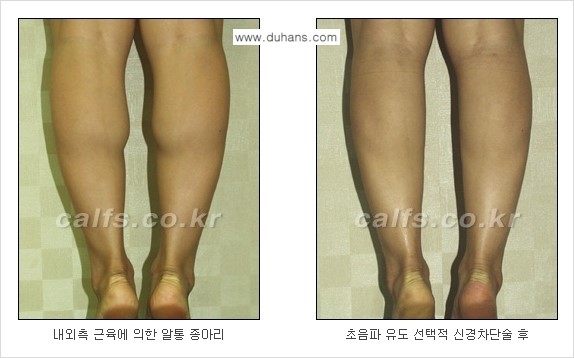 ​[두한성형외과와 날씬한 종아리 만들기!] - [간편하고 안전한 종아리 축소방법 ④] 관련 이미지 11