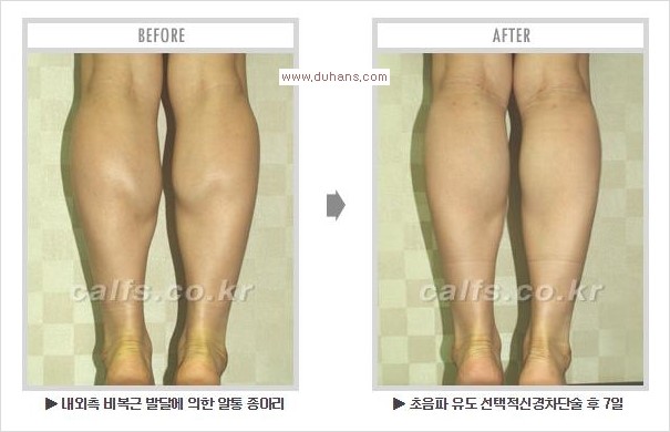 [두한성형외과 경쟁력 멀티종아리성형] - [알통종아리 해결 - 비절개 초음파 선택적 신경차단술] 관련 이미지 16