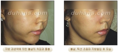 [두한성형외과 안전한 지방흡입] - [얼굴지방흡입] 관련 이미지 22