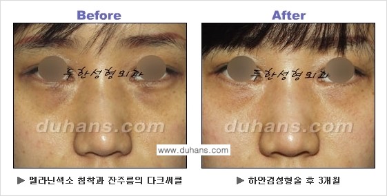 [두한성형외과의 상큼하고 환한 젊은 눈매완성] - [하안검 성형술 ②] 관련 이미지 19