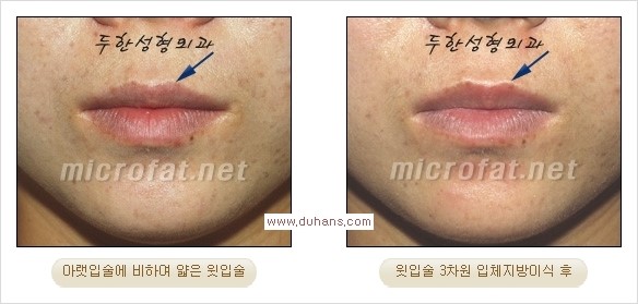 [두한성형외과 경쟁력 미세지방이식] - [입술 3차원 입체지방이식 안내 1.] 관련 이미지 12