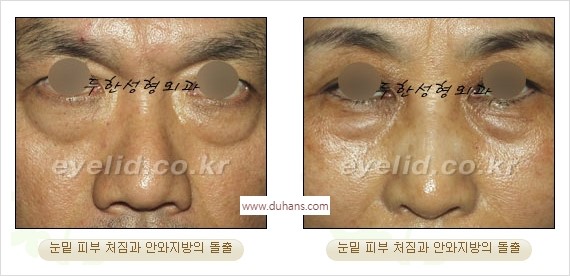 [두한성형외과 경쟁력 안검성형] - [눈밑주름 제거수술] 관련 이미지 2