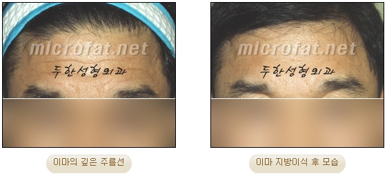 [두한성형외과 이마성형] - [엔도타인리프팅, 이마지방이식]​ 관련 이미지 32
