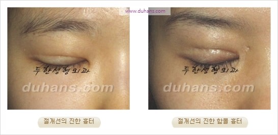 [두한성형외과 경쟁력 쌍꺼풀 재수술 리더] - [쌍꺼풀 흉터선, 쌍꺼풀 흉터 유착 교정술 안내] 관련 이미지 7