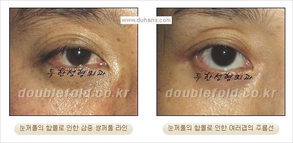 [두한성형외과 경쟁력 쌍꺼풀 재수술] - [삼중(세겹) 쌍꺼풀 라인, 눈꺼풀이 함몰된 삼중(세겹) 쌍꺼풀 라인 교정] 관련 이미지 9