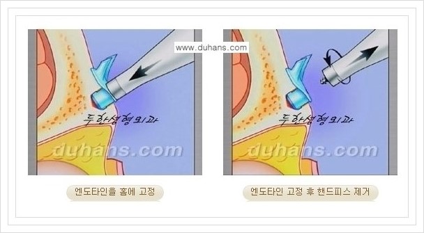 [두한성형외과 경쟁력 주름성형] - [회복과 일상으로의 복귀가 빠른 눈썹거상, 이마주름 엔도타인 리프팅] 관련 이미지 11