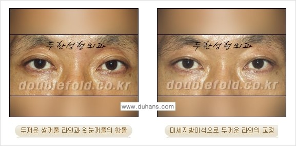 [두한성형외과 NO.1 눈성형] - [함몰된(꺼진) 눈꺼풀에서 쌍꺼풀 라인 교정 2.] 관련 이미지 5
