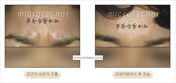 [두한성형외과 경쟁력 주름성형] - [주름 교정을 위한 안전하고 효과적인 미세지방이식] 관련 이미지 8