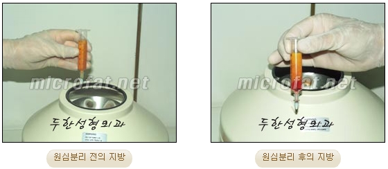 [Duhan Plastic Surgery Face Autologous Fat Grafting] - [Noble Surgery and Indian Band Fat Grafting] image 13