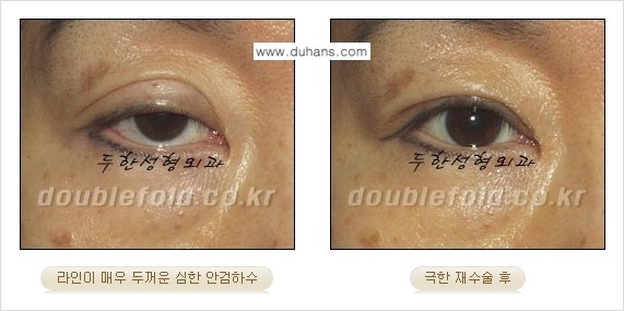 [두한성형외과 경쟁력 눈성형] - [극한의 상태에서 쌍꺼풀재수술(눈재수술) 안내] 관련 이미지 18