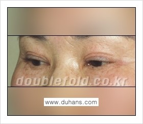 [두한성형외과 경쟁력 쌍꺼풀 재수술] - [쌍꺼풀 재수술의 대상과 해당 쌍꺼풀 재수술 방법 안내] 관련 이미지 7
