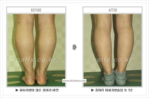 [두한성형외과 경쟁력 멀티종아리성형] - [종아리성형 방법별 전후 주의사항] 관련 이미지 30
