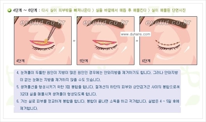 [두한성형외과 경쟁력 눈성형] - [절개법, 매몰법 쌍꺼풀 수술 안내] 관련 이미지 2