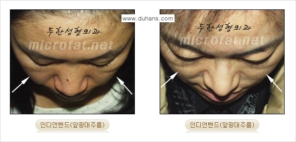 [두한성형외과의 경쟁력 미세지방이식] - [귀족수술과 인디언밴드 미세지방이식 안내 ①] 관련 이미지 4