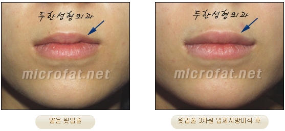 [Duhan Plastic Surgery Lip Surgery] - [Lip Correction Fat Grafting] image 9
