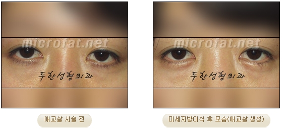 ​[두한성형외과 지방이식] - [애교살] 관련 이미지 21