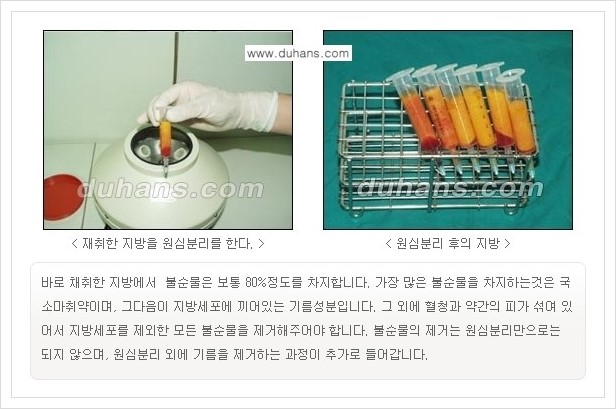 [두한성형외과 경쟁력 미세지방이식] - [자연스러운 코높임 지방이식 안내 ①] 관련 이미지 7