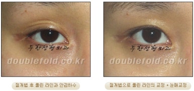 [두한성형외과 쌍커플 재수술] - [비절개눈매교정 재수술] 관련 이미지 43