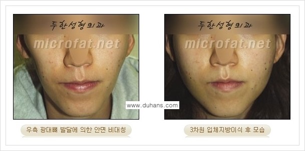 [두한성형외과 경쟁력 윤곽성형] - [볼, 볼살 지방이식] 관련 이미지 27