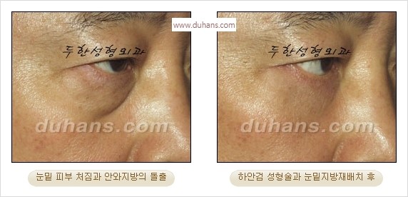 [두한성형외과 경쟁력 안검성형] - [눈밑주름 제거수술] 관련 이미지 8