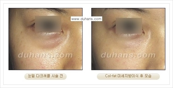 [두한성형외과 경쟁력 미세지방이식] - [지방이식 특허 Col-fat 미세지방이식 성공사례 안내] 관련 이미지 6