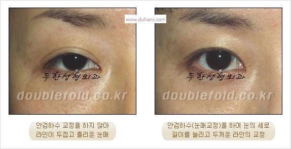 [두한성형외과 경쟁력 눈성형] - [쌍꺼풀 재수술 실패의 원인과 문제점] 관련 이미지 9