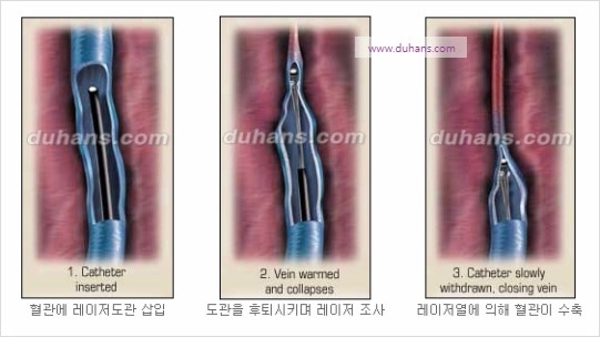 [두한성형외과 경쟁력 정맥류 치료] - [정맥류 치료의 모든 것] 관련 이미지 19