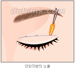 쌍커풀수술 두한성형외과 - 나에게 맞는 눈성형은? 관련 이미지 22